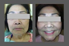 before and after treatment at NorthShore Center for Oral & Facial Surgery and Implantology