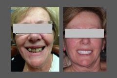 before and after treatment at NorthShore Center for Oral & Facial Surgery and Implantology