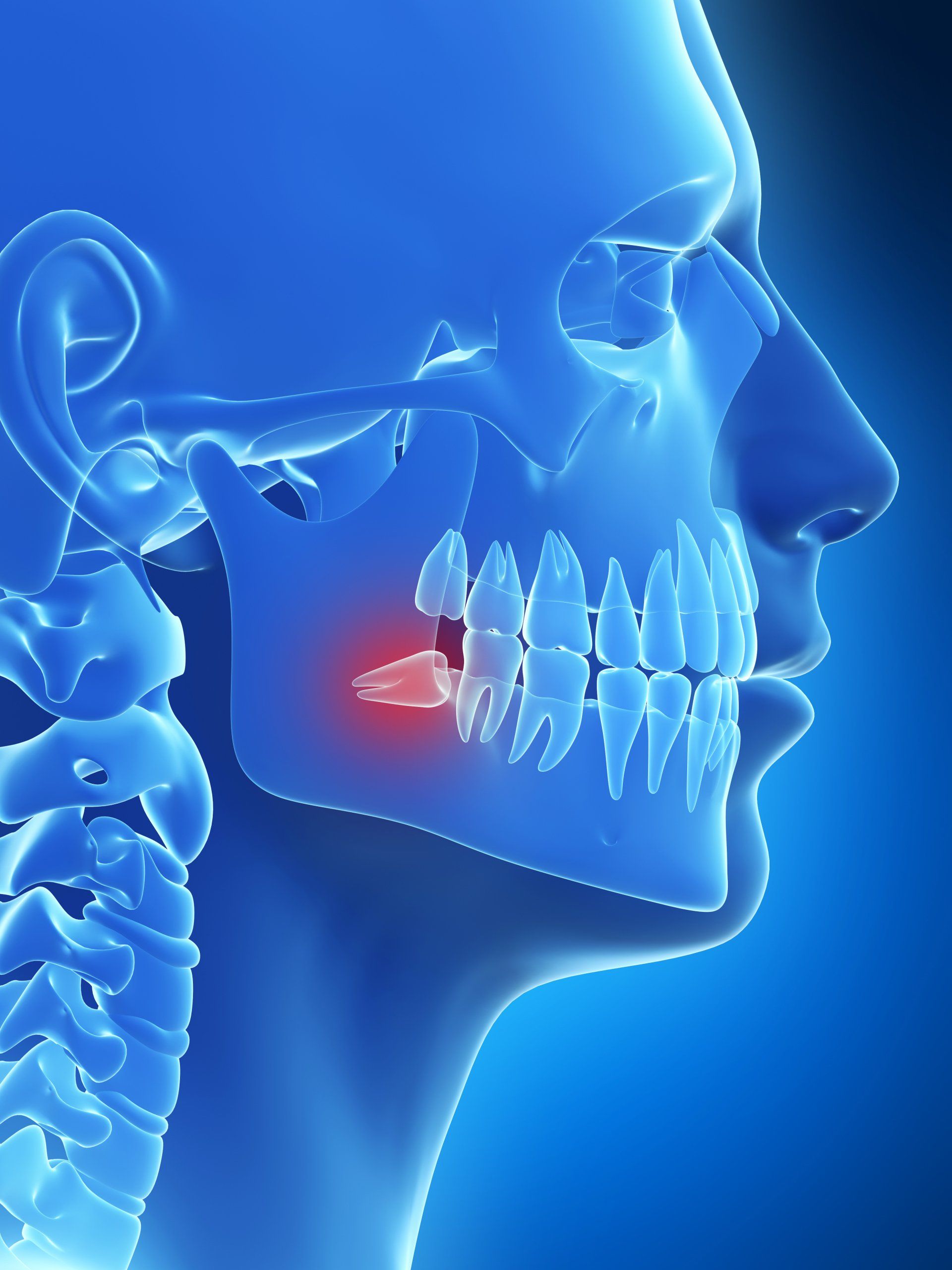 Read more about the article Wisdom Teeth and Your Overall Health: Potential Long-Term Effects