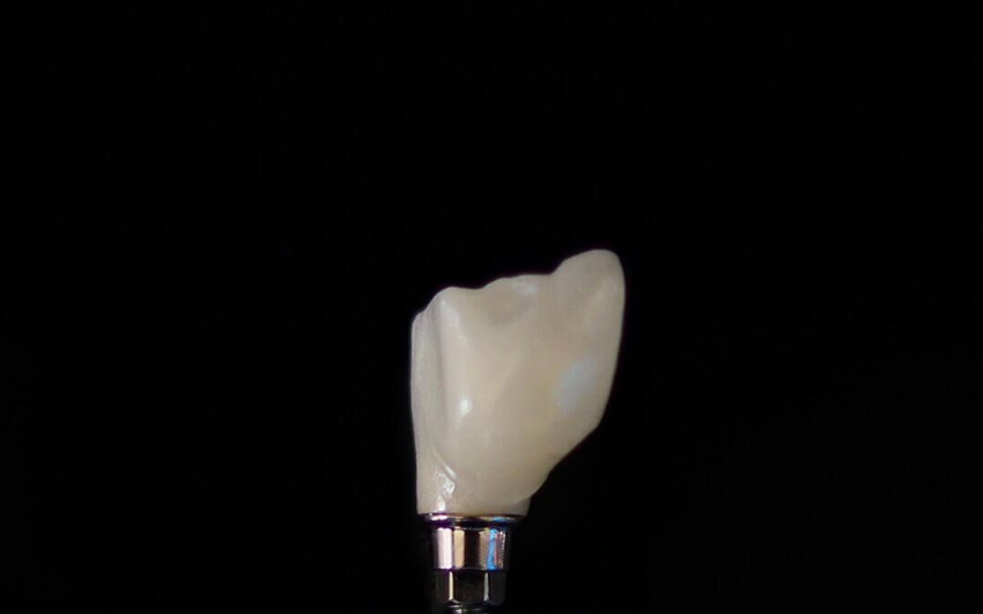 How to Verify Quality Dental Implants in Gurnee