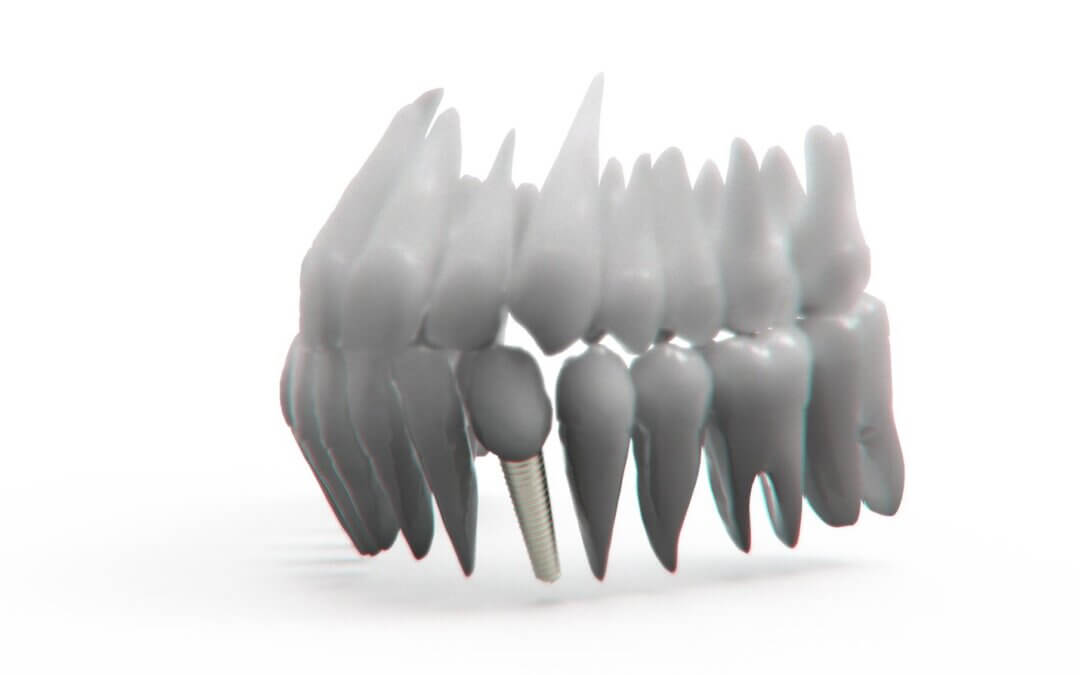 Reclaim Your Daily Confidence by Stopping Chronic Denture Pain